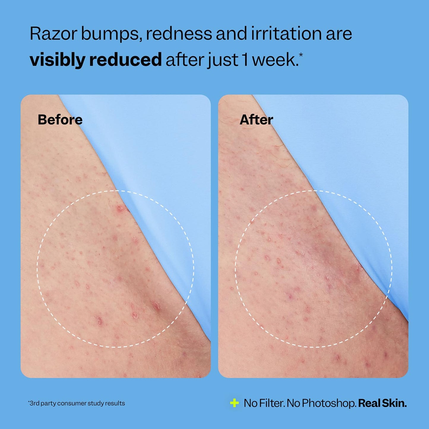 Smoothing Solution Ingrown Hair Treatment: Glide Your Way to Silky-Smooth, Bump-Free Skin